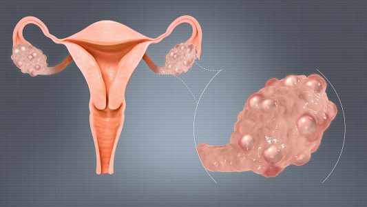 All you need to know about PCOS - PCOS Specialist in Delhi - Dr. Madhu Goel