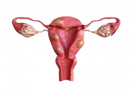 uterine fibroids treatment in south delhi