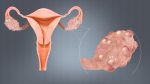 Polycystic ovary syndrome (PCOS) – Diagnosis and treatment