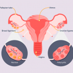 Best Gynecological Treatments for Polycystic Ovary Syndrome (PCOS) - Dr. Madhu Goel