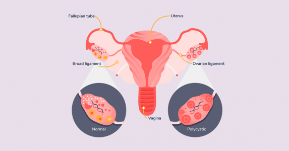 Best Gynecological Treatments for Polycystic Ovary Syndrome (PCOS) - Dr. Madhu Goel