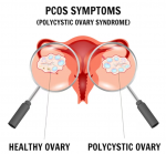 Polycystic Ovary Syndrome (PCOS): Symptoms, Management, and Fertility