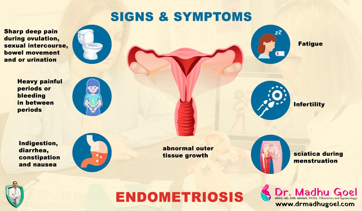 Illustration of Endometriosis Signs and Symptoms Explained