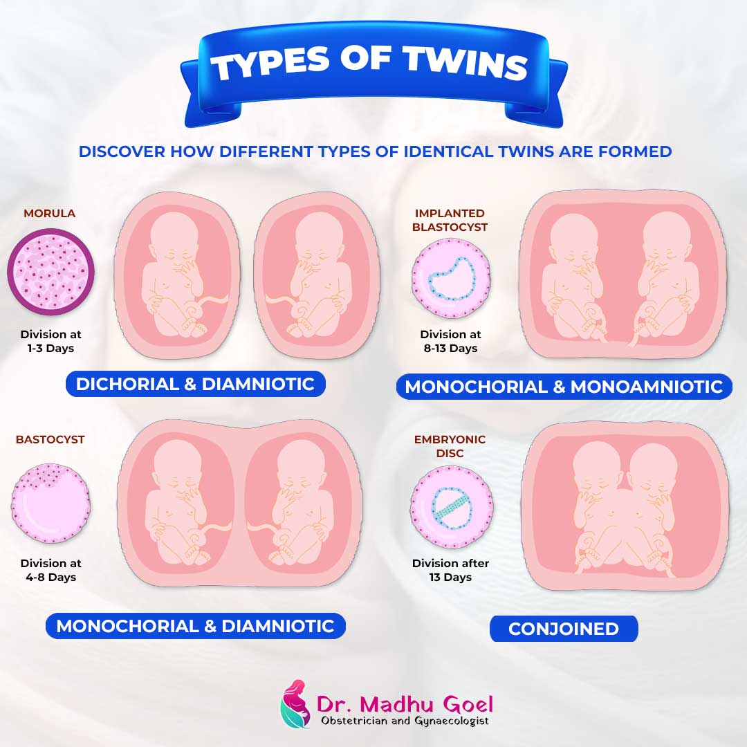 Types of Twin Pregnancy