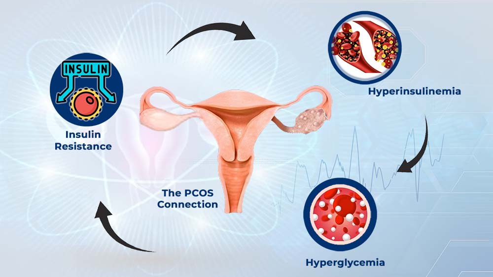 PCOS Causes Explained: From Hormonal Imbalance to Insulin Resistance ...
