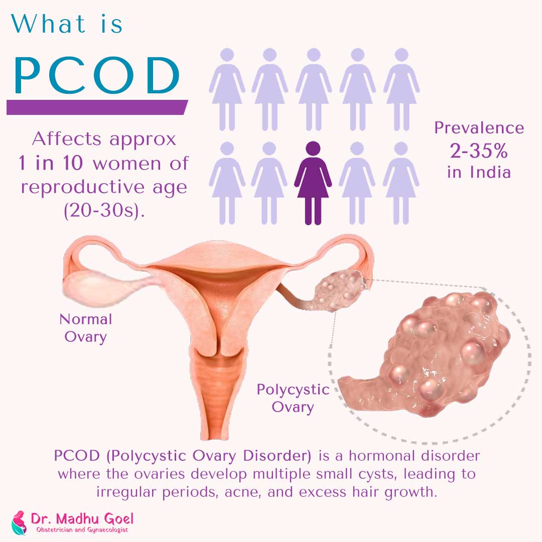 Pcod Acnes Decoding the PCOD Diagnosis: Understanding Tests and Evaluations - Dr ...