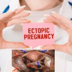 ectopic pregnancy
