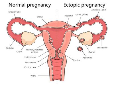 non-viable pregnancy