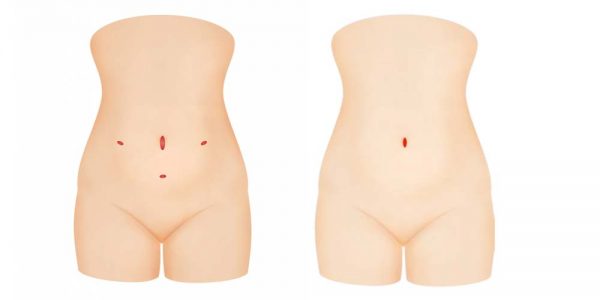 Illustration of four small incision sites used in traditional 4-port laparoscopic surgery on the abdomen.