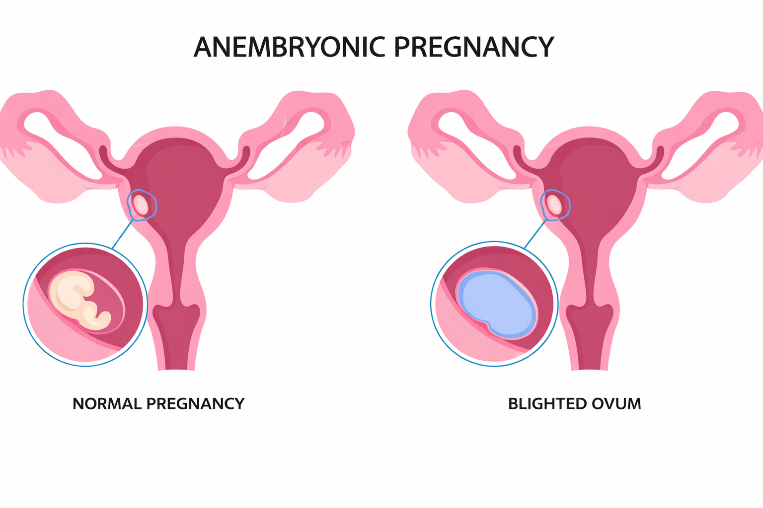normal pregnancy vs blighted ovum empty gestational sac comparison
